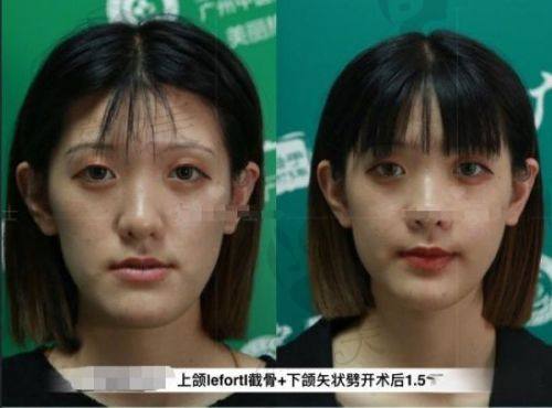 成都八大处小耳畸形手术费用多少？中度收费5