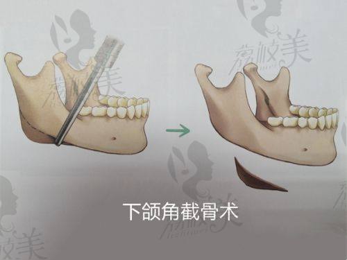 成都八大处耳再造费用多少钱？实力医生+特色技术，4