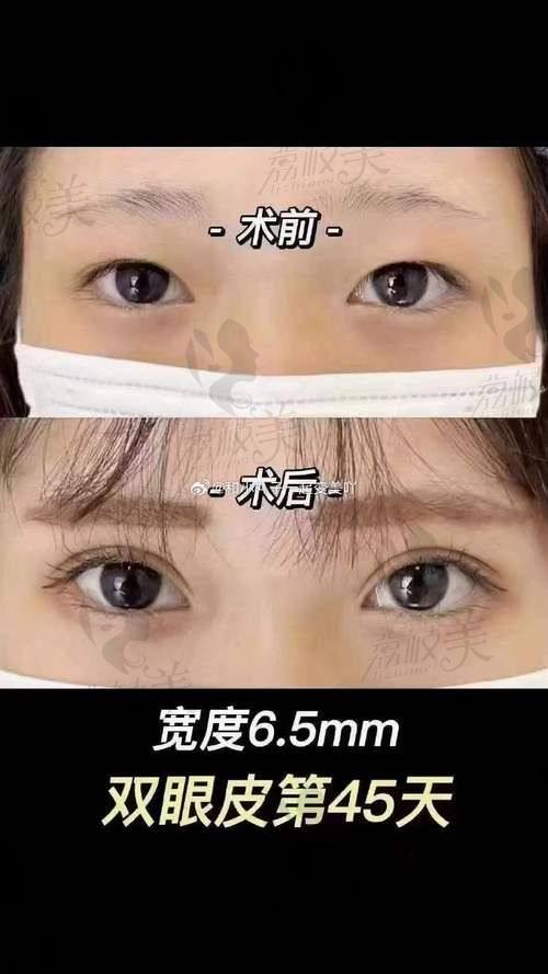邯郸美弧美润 5800 - 16800 元双眼皮：开启你的美丽之旅