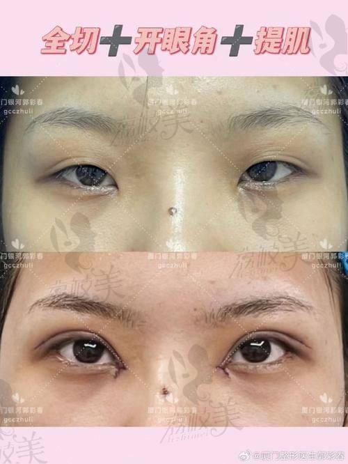 邯郸美弧美润口碑爆棚：5800 - 16800 元双眼皮的真实见证