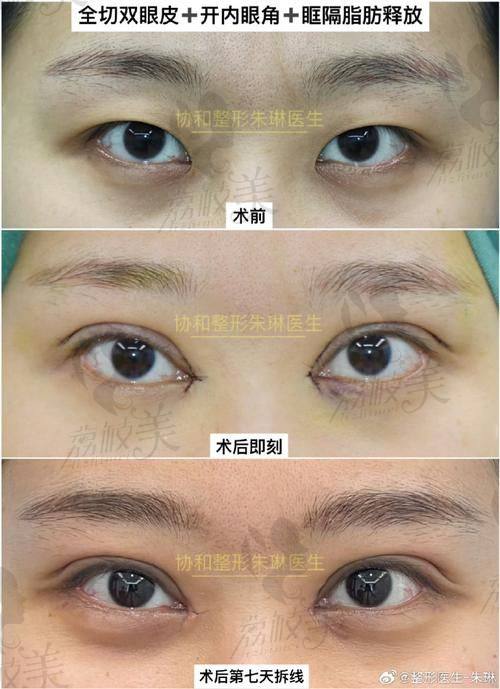 选择吕瑛医生做提眉 + 眼窝填充有哪些优势？