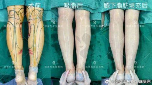 重庆刘彦龙吸脂怎么样？技术高且价格合适是不少求美者喜欢的医生