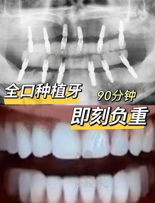 沈阳德立联合口腔郑淳奎做德国迪瑞种植牙的技术优势