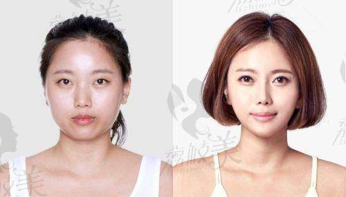 台州艺星医疗美容医院在双眼皮项目上的优势