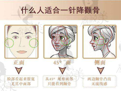 乌鲁木齐华美整形黄江泊腰腹吸脂的实例分享