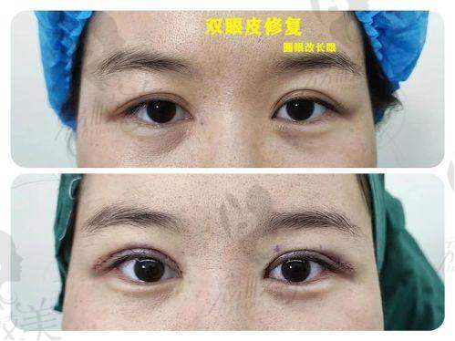 郑州郭晓光做双眼皮怎么样？带你看看郑州天后整形医院郭晓光案例解析
