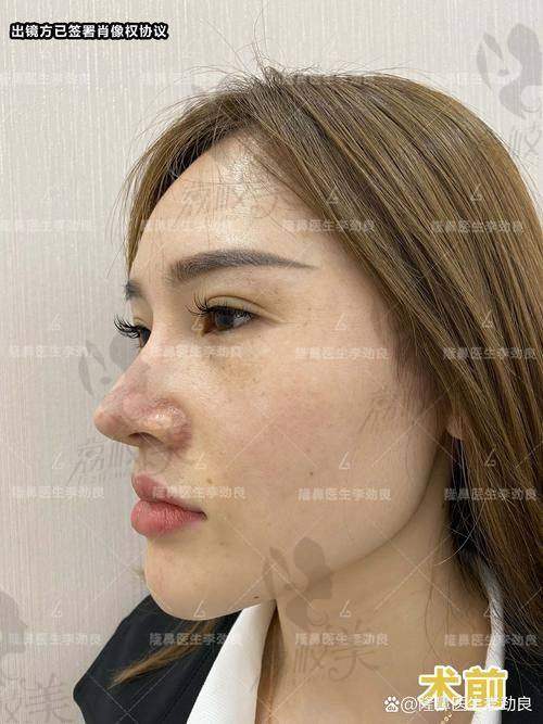 南昌阅美医疗美容吕建华双侧耳软骨鼻综合20800元起,打造自然挺翘美鼻效果惊人
