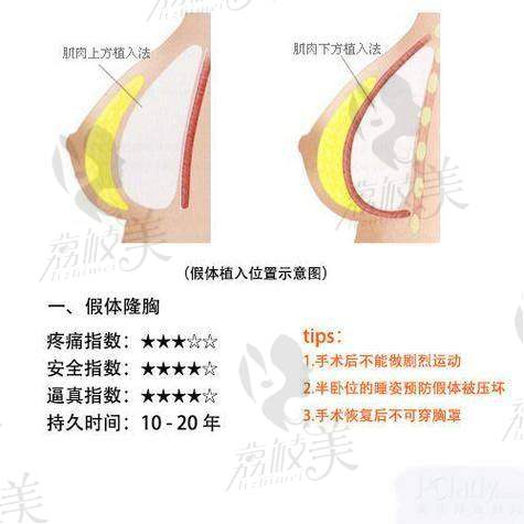 南昌阅美医疗美容吕建华傲诺拉假体隆胸88000元起,精湛技术塑造自然美胸效果!