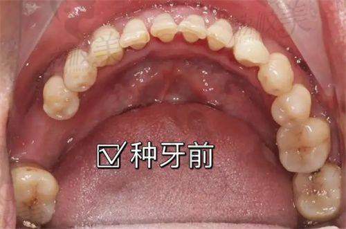 六、植是道种植体适合哪些人用？