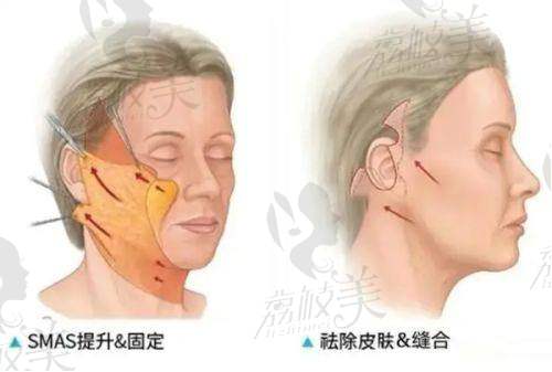 美体塑形项目