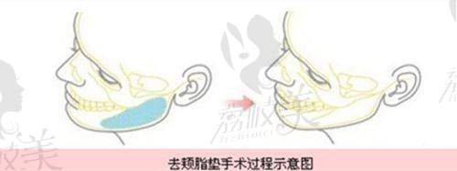 长沙雅美整形美容胡艺觉医生眼部年轻化3900元起 - 精细创口小