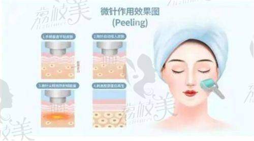 再希斯黄金微针 Pro 代数情况