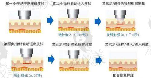 帝医思黄金微针价格详情