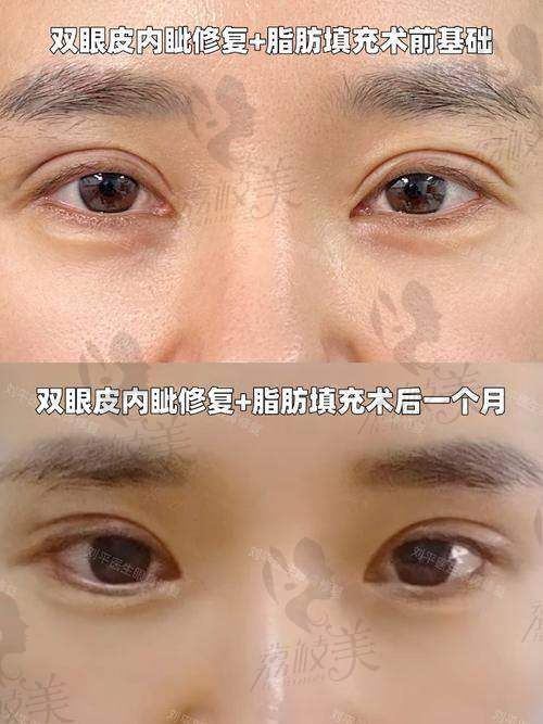 长沙雅美双眼皮医生的价格差异大吗？