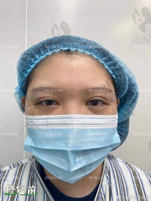 如何选择适合自己的长沙雅美双眼皮医生？