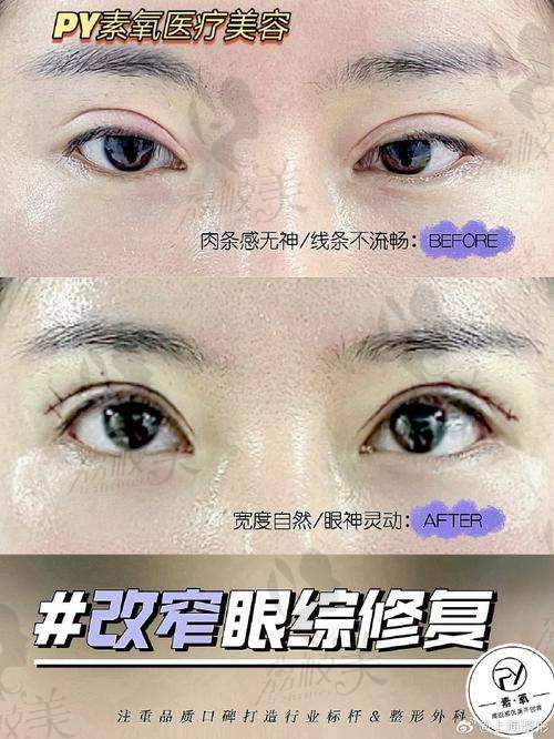 长沙雅美双眼皮医生的技术实力如何？