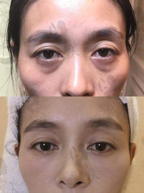 祛眼袋手术进行时