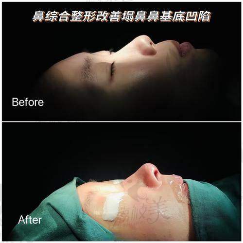 杭州艺星徐利刚做的肋骨鼻子绝了，收费6万8立体自然宛若天生性价比之王