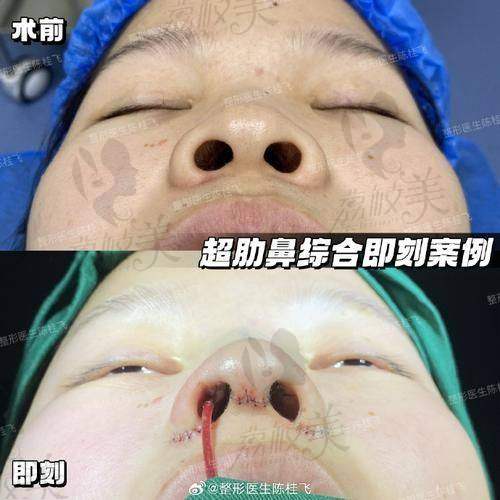 中山贝熙医疗美容医院王牌医生：打造美鼻的神奇之手