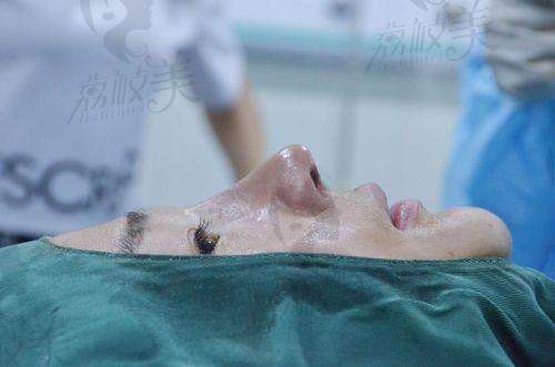 中山贝熙医疗美容医院驼峰祛除真人实例：见证美鼻奇迹