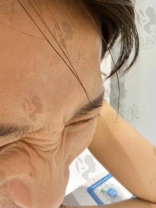 不同职业/人群对额头川字纹方案的选择建议