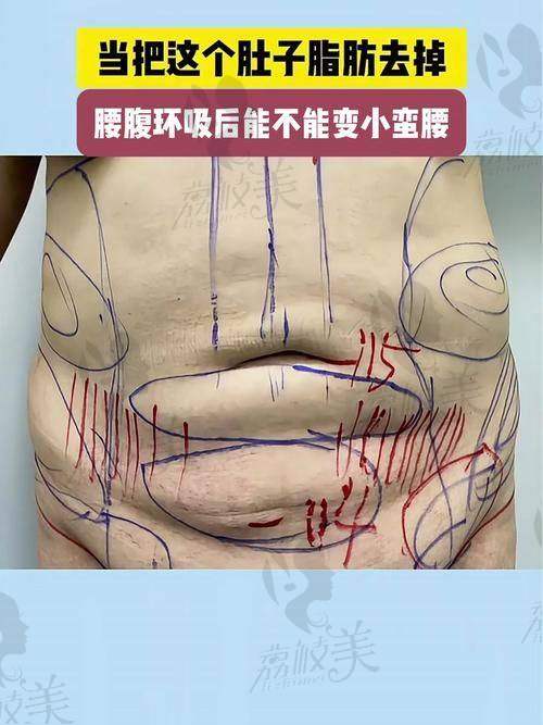 王棚医生：腰腹环吸的专精之选