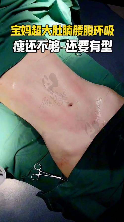 长沙雅美王少甫腰腹吸脂15800元起，技术精细恢复快，手术满意率超九成！