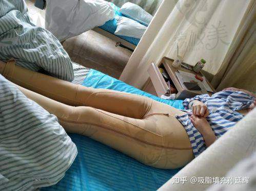 重庆军科王棚大腿吸脂16000元起，微创无痕助您塑造迷人笔直美腿！