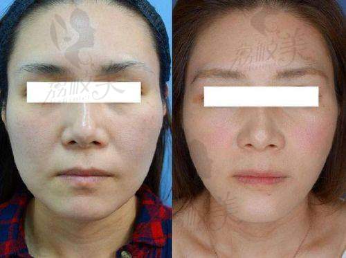 深圳福雅医疗美容医院范开防面部筋膜提升8800元起，重塑紧致轮廓效果惊艳