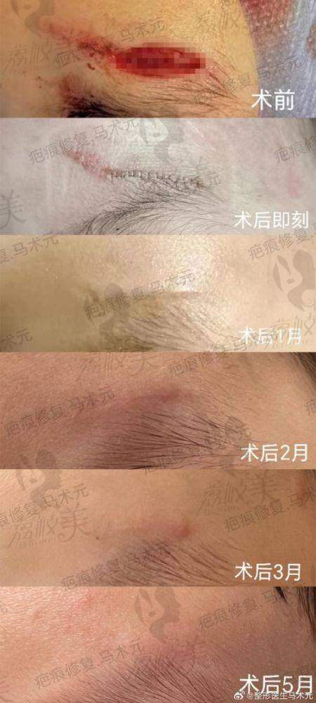 腋臭治疗科室专精化，治疗方式多样、修复成效佳