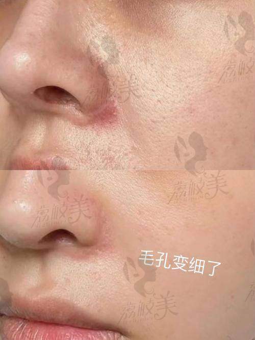 帝医思黄金微针和再希斯的关系解析
