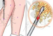 北京禾美嘉任学会大腿吸脂45000元起，精湛技术助你拥有纤细美腿不是梦