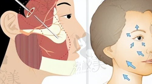 北京画美医院董岩岩医生隆胸20000元起——出血少超自然