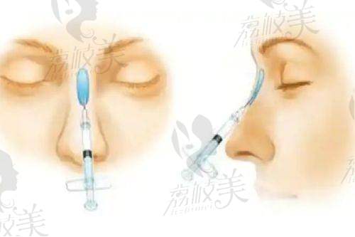 北京画美医院王慧文医生双眼皮成形术4800元起，精细效果佳
