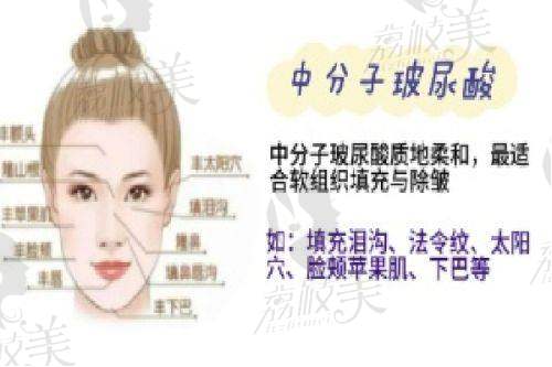 (五)面部填充——自体脂肪全脸精细化雕刻