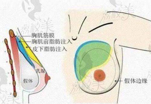 北京嘉禾医疗美容孙景波医生双眼皮失败修复7800元起，精准修复超自然