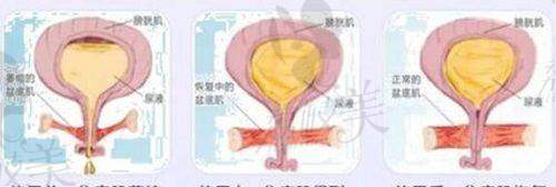 北京润美玉之光医疗美容张红芳面部脂肪精准填充6800元起——填充精准且自然