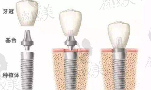 三、正畸项目2025价目大起底——牙套界的“显眼包”贵在哪也讲明白