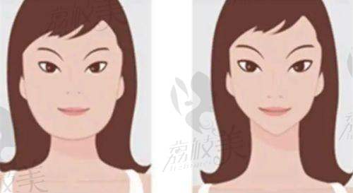 北京京城皮肤医院京萨医生疤痕综合治疗38000元起——修复自然度高