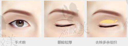 北京画美医院赵映贤医生J - LOCK无痕重睑术3800元起，自然持久之选