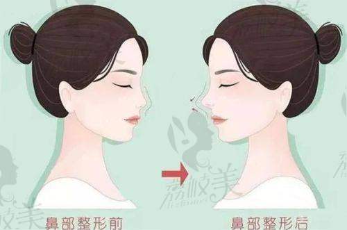 (二)眶隔年轻化