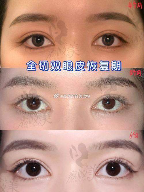 南昌阅美医疗美容吕建华做大眼综合12800元起，精湛技艺打造灵动美眸效果惊人
