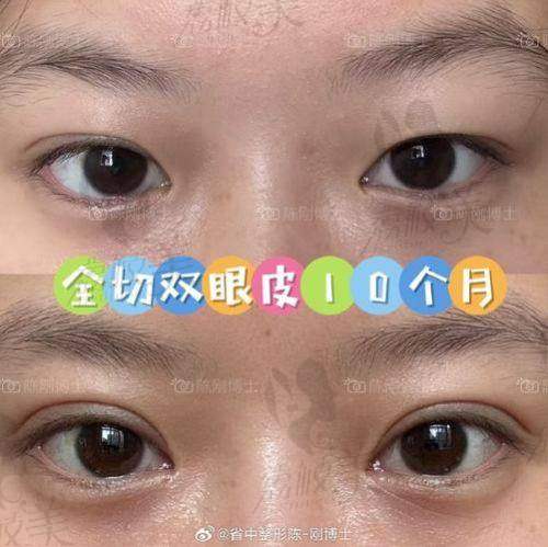 吕方中双眼皮修复适合哪些人群？术前这几点别忽视