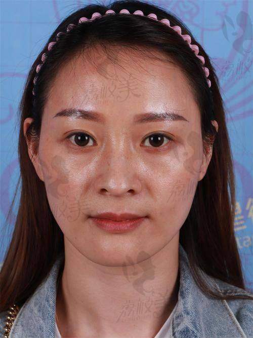 南昌阅美医疗美容吕建华自体脂肪填充13800元起，自然塑形效果备受瞩目！