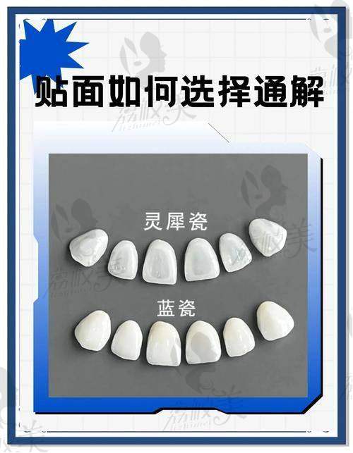 打造自然闪耀笑容：牙贴面的优势解读