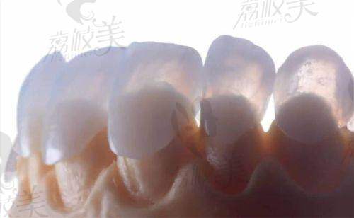 结语：别让笑容缺角，贴面帮你画龙点睛