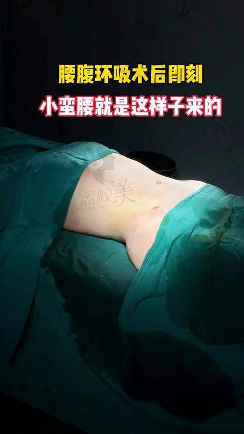 禾美嘉任学会腰腹吸脂4.6W元起，助您告别水桶腰秒变性感小蛮腰！
