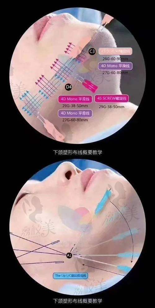 微拉美哪家医院做的好？广州中家医、北京华韩等医院不容错过！