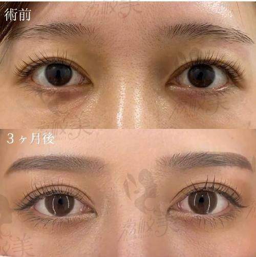 上海郑小红埋线修复双眼皮费用2w左右，无痕放大双眼轻松拿捏氛围感