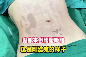 长沙亚韩徐敬宾腰腹环吸28000元起，分层吸脂塑造清晰“S”型腰线！ 